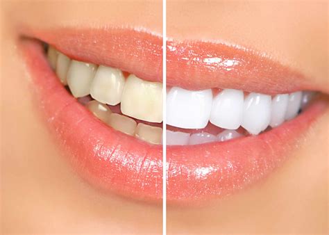 Can Magic White Teeth Whitening Remove Deep Stains?